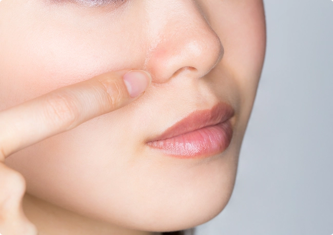 小鼻が横に広がる原因