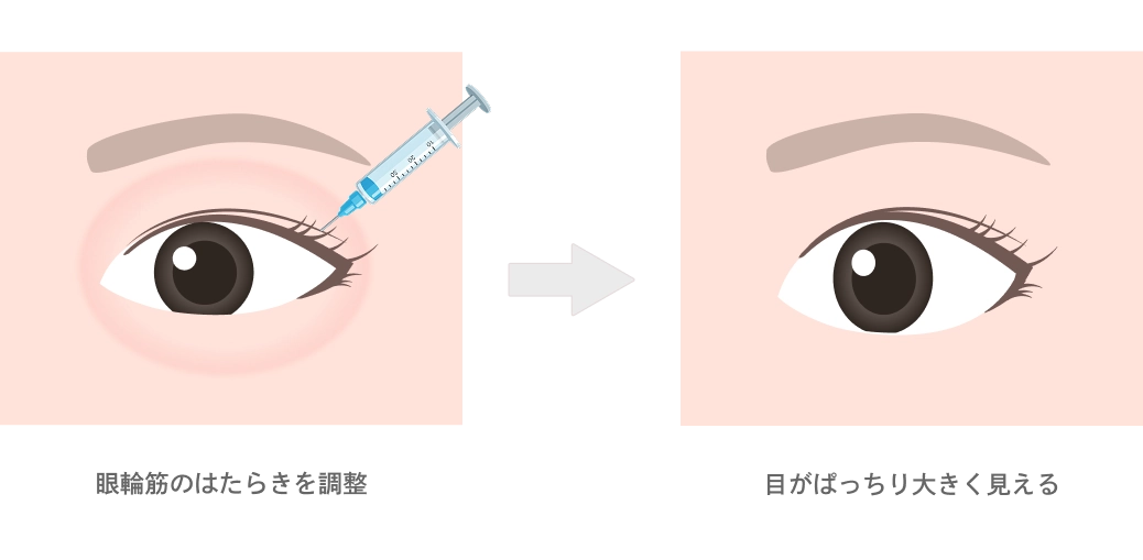目デカボトックス注射