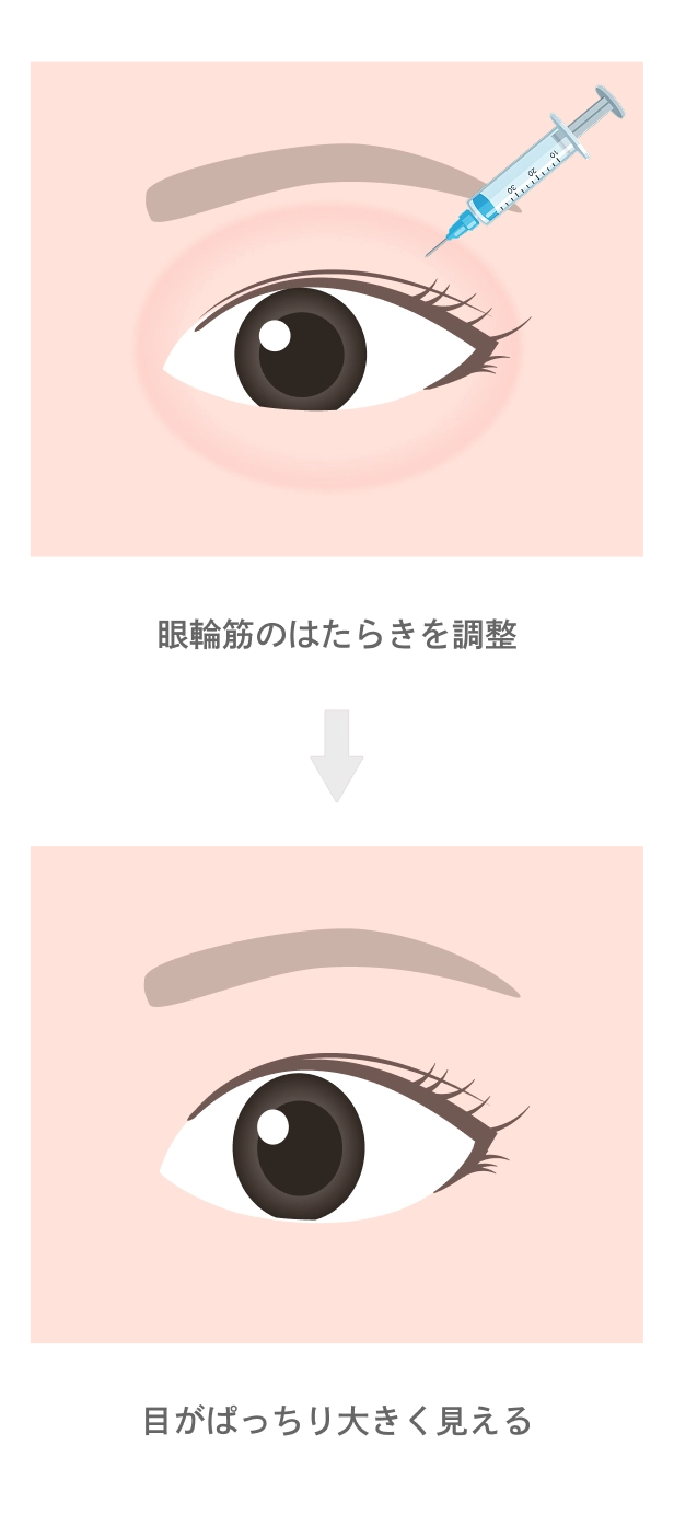 目デカボトックス注射