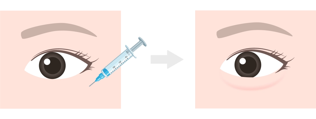 涙袋のヒアルロン酸注入とは