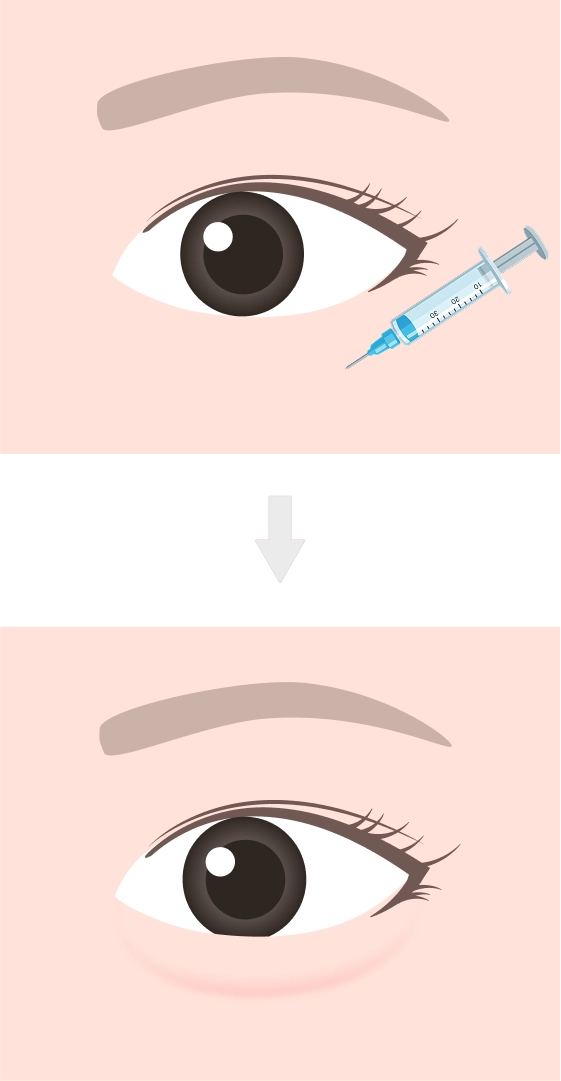 涙袋のヒアルロン酸注入とは