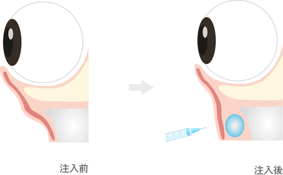 目の下のヒアルロン酸注入とは