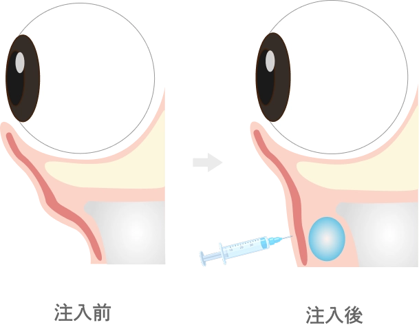 目の下のヒアルロン酸注入とは
