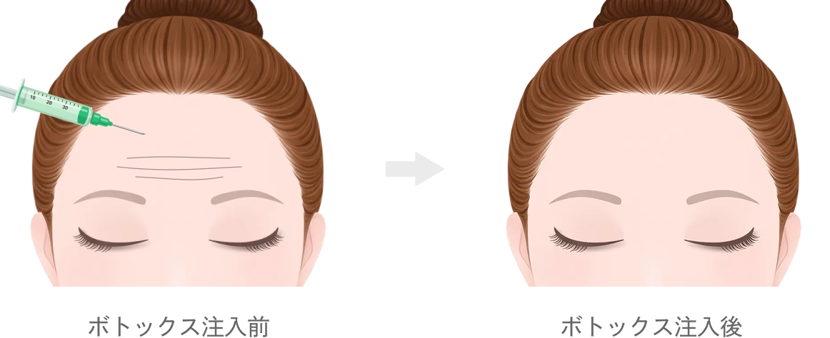 額のボトックス注射（額・こめかみのヒアルロン酸注入ページ）