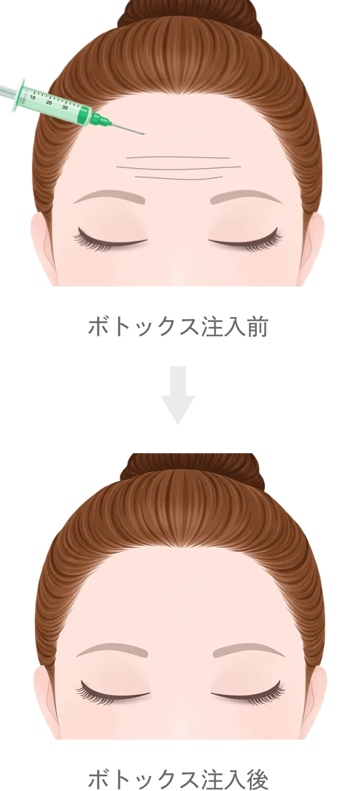 額のボトックス注射（額・こめかみのヒアルロン酸注入ページ）