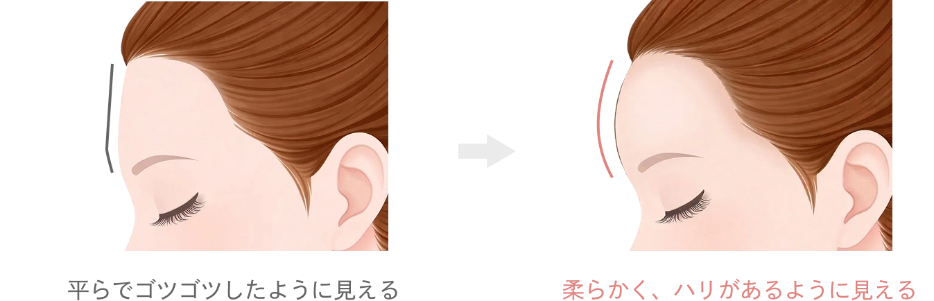 額・こめかみのヒアルロン酸注入とは