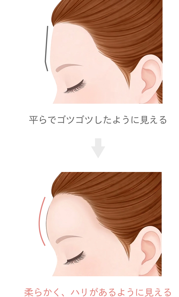 額・こめかみのヒアルロン酸注入とは