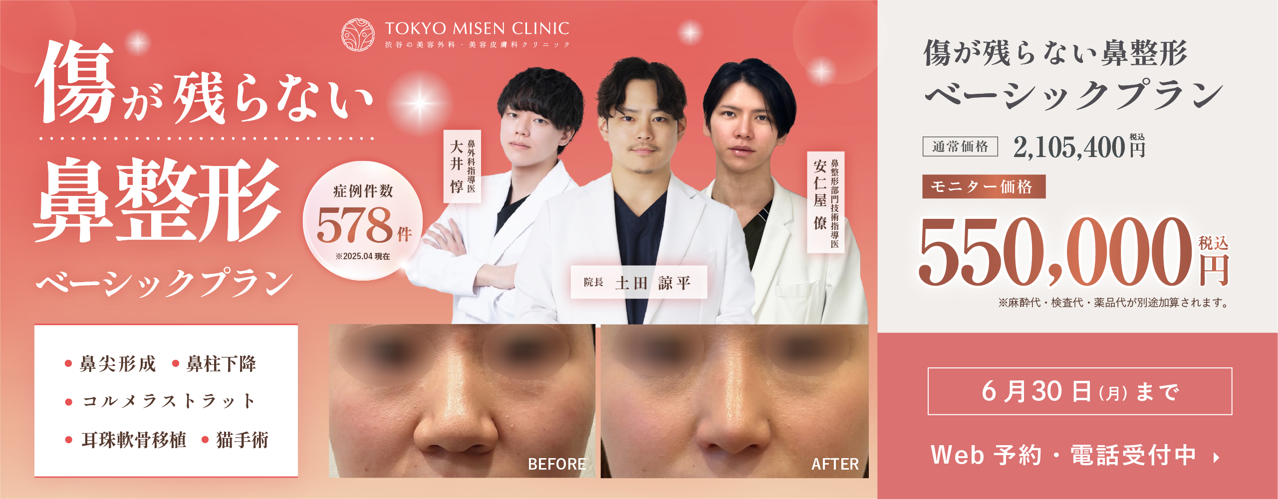 6月鼻フル整形