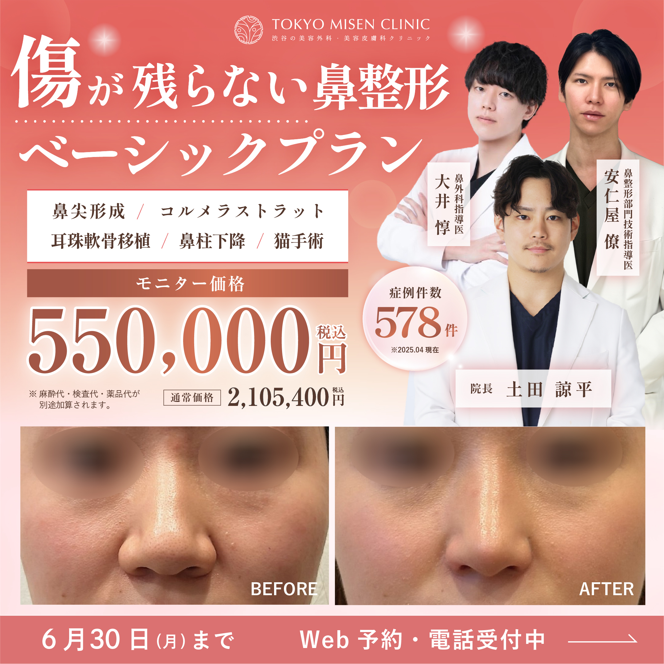 6月鼻フル整形