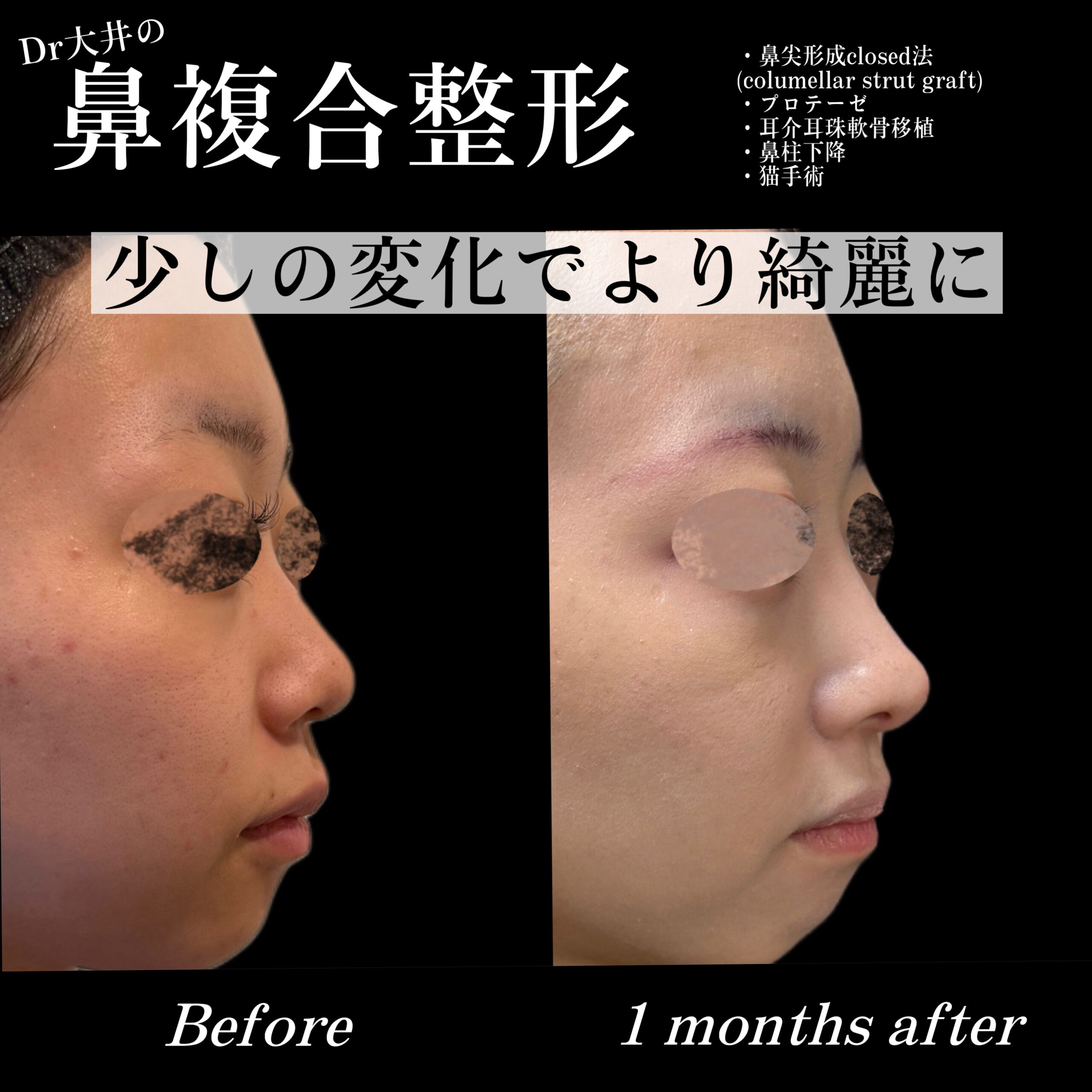 鼻尖形成(closed)・プロテーゼ・耳介耳珠軟骨移植（コルメラストラット含む）・鼻柱下降・猫手術