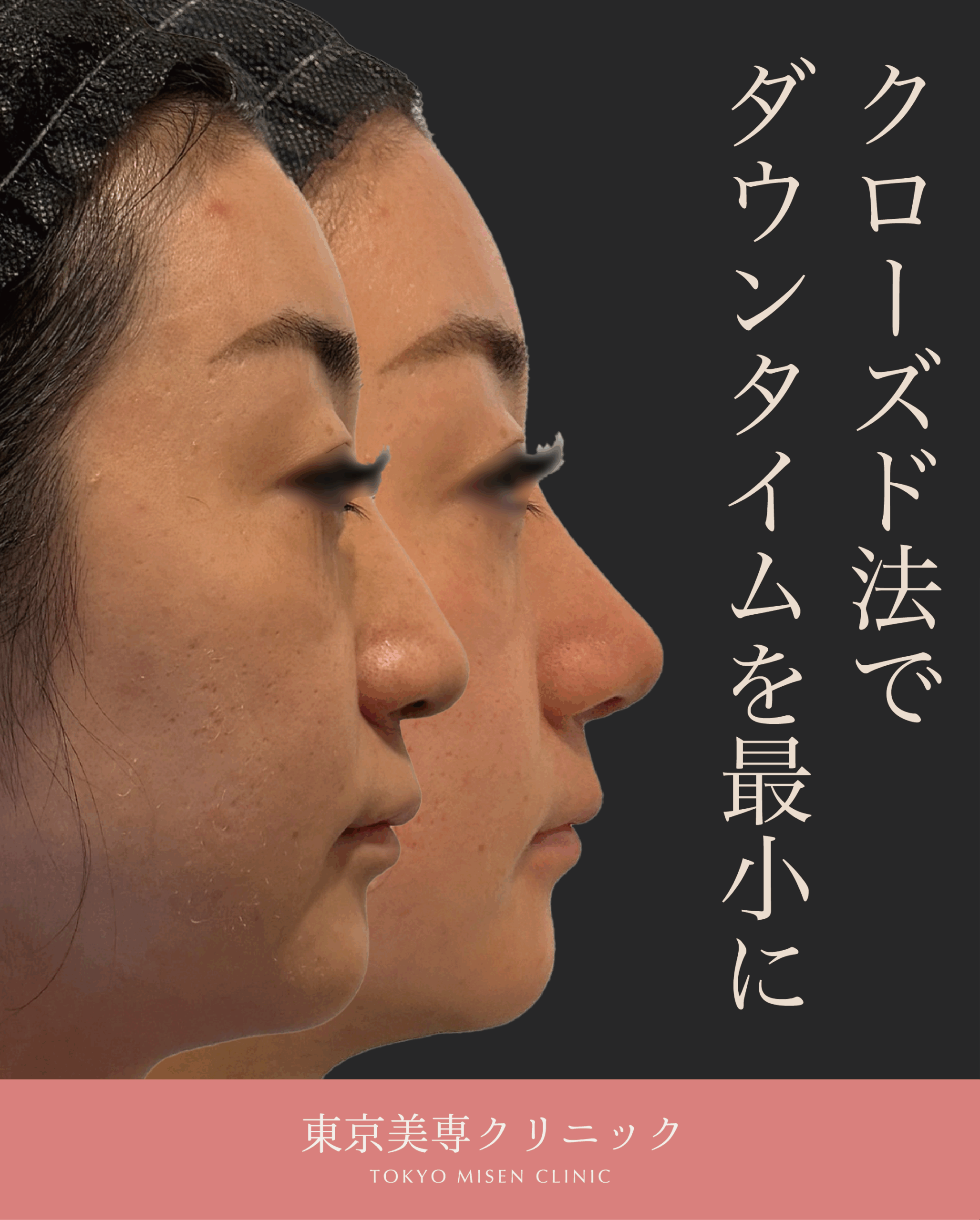 鼻尖形成(closed)・耳介耳珠軟骨移植（コルメラストラット含む）・鼻柱下降・猫手術