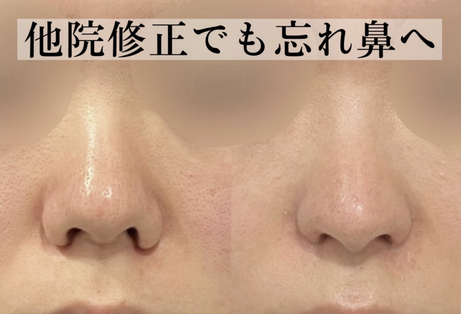 鼻尖形成(closed)・耳介耳珠軟骨移植（コルメラストラット含む）・鼻柱下降・鼻翼縮小・鼻翼挙上・鼻孔縁挙上・猫手術
