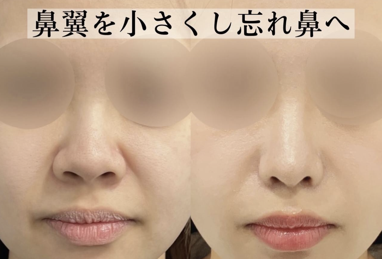 鼻尖形成(closed)・耳介耳珠軟骨移植（コルメラストラット含む）・鼻柱下降・鼻翼縮小
