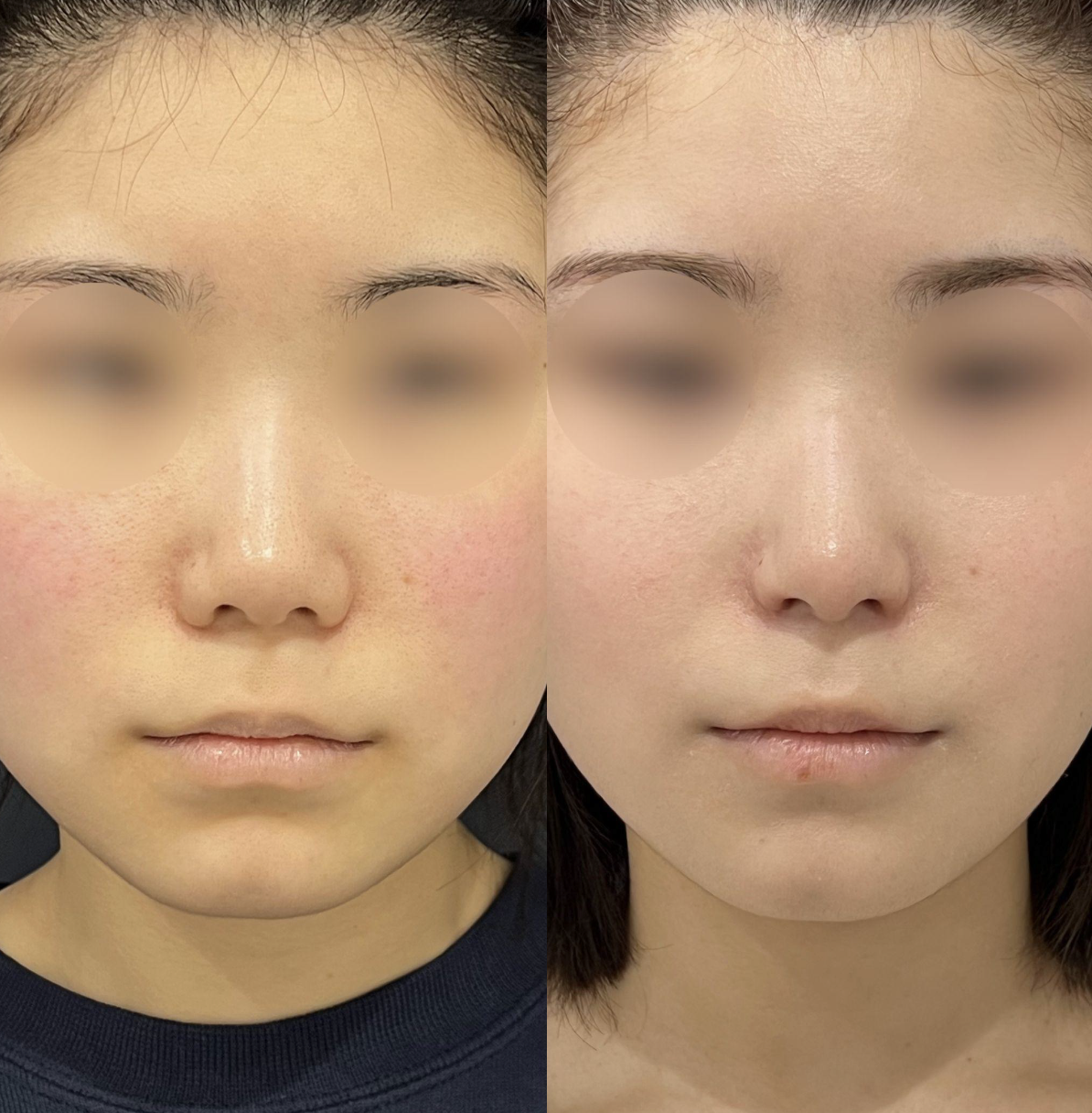 鼻尖形成(closed)・耳介耳珠軟骨移植（コルメラストラット含む）・鼻柱下降・鼻翼縮小