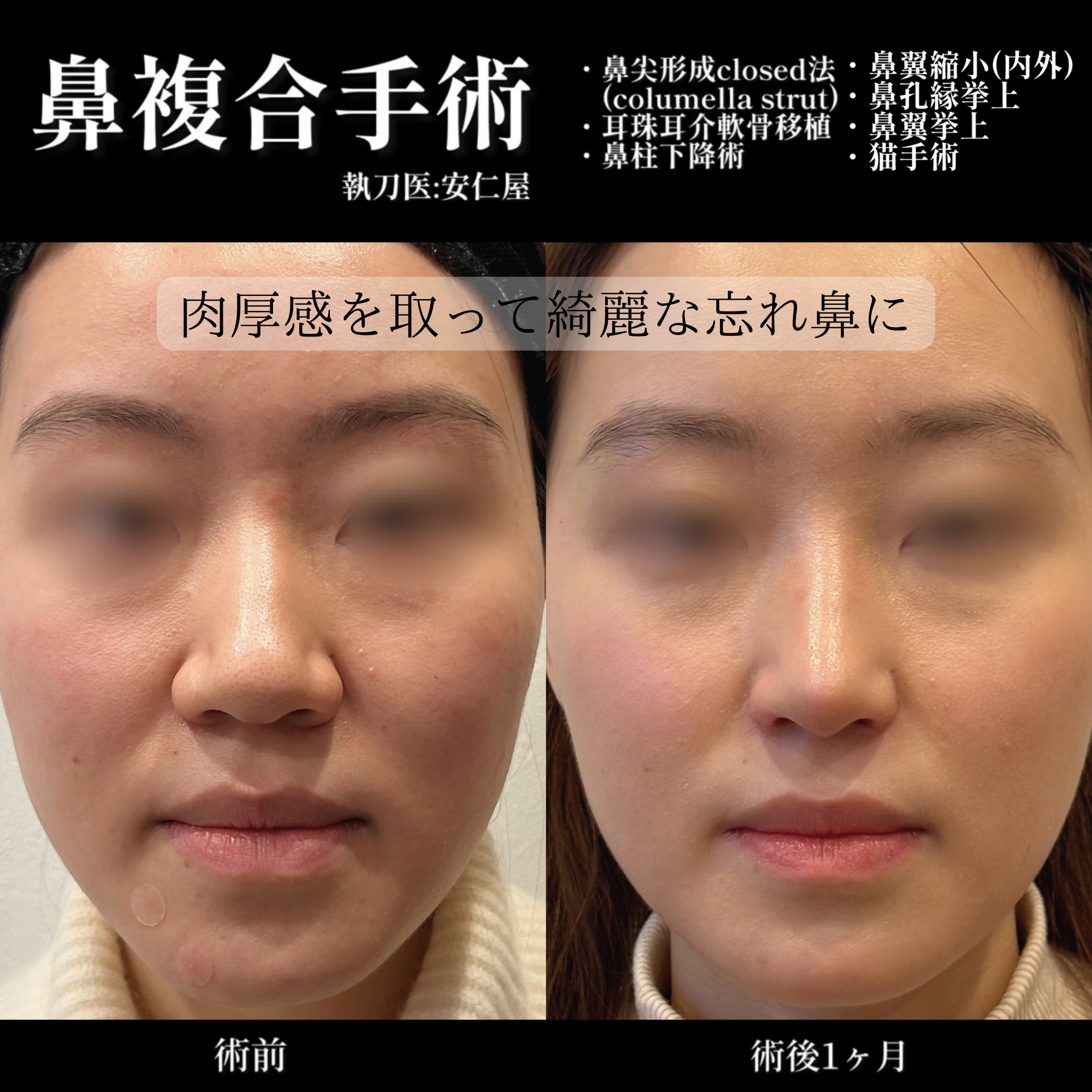 鼻尖形成(closed)・耳介耳珠軟骨移植（コルメラストラット含む）・鼻柱下降・鼻翼縮小・鼻翼挙上・鼻孔縁挙上・猫手術
