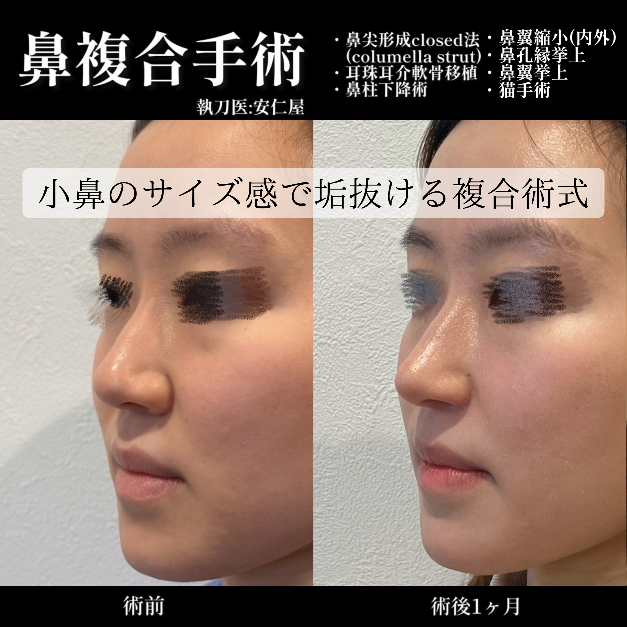 鼻尖形成(closed)・耳介耳珠軟骨移植（コルメラストラット含む）・鼻柱下降・鼻翼縮小・鼻翼挙上・鼻孔縁挙上・猫手術