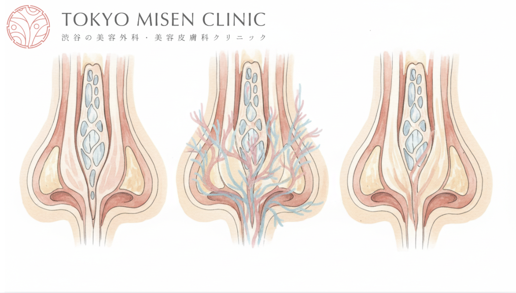 鼻プロテーゼは一生もつ？入れ替え時期と長期経過で起こる変化を徹底解説