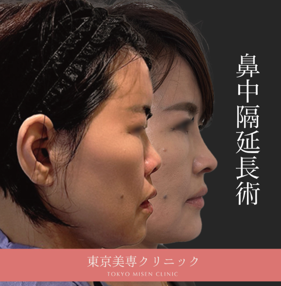 鼻プロテーゼ＋鼻中隔延長＋鼻尖形成＋耳珠軟骨移植＋鼻柱下降＋猫貴族手術