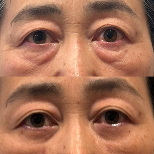 表ハムラ＋余剰皮膚切除